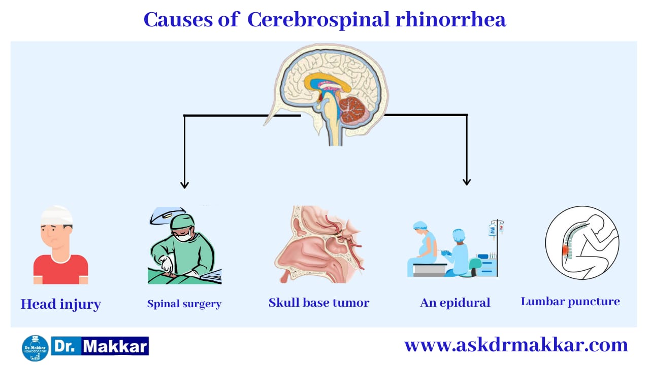 cerebrospinal-rhinorrhea-nasal-fluid-brain-csf-leakage-causes